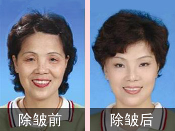 永康玻尿酸除皱效果